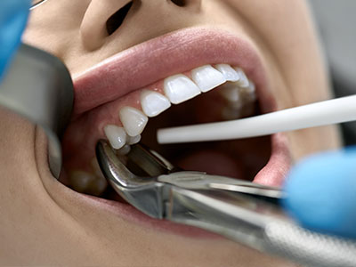 Elite Dental Club | Root Canals, Digital Radiograph and Cosmetic Dentistry