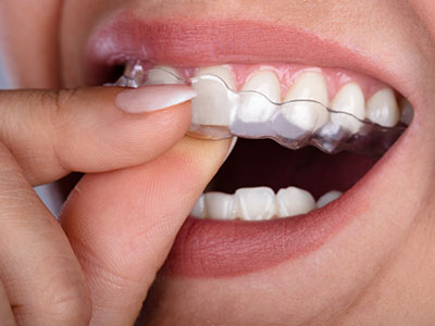Elite Dental Club | Crowns  amp  Caps, Teeth Whitening and Teeth Cleaning