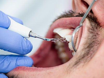 Elite Dental Club | Crowns  amp  Caps, Digital Radiograph and Cosmetic Dentistry