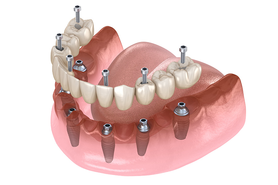 Elite Dental Club | CEREC, Oral Exams and Overdentures
