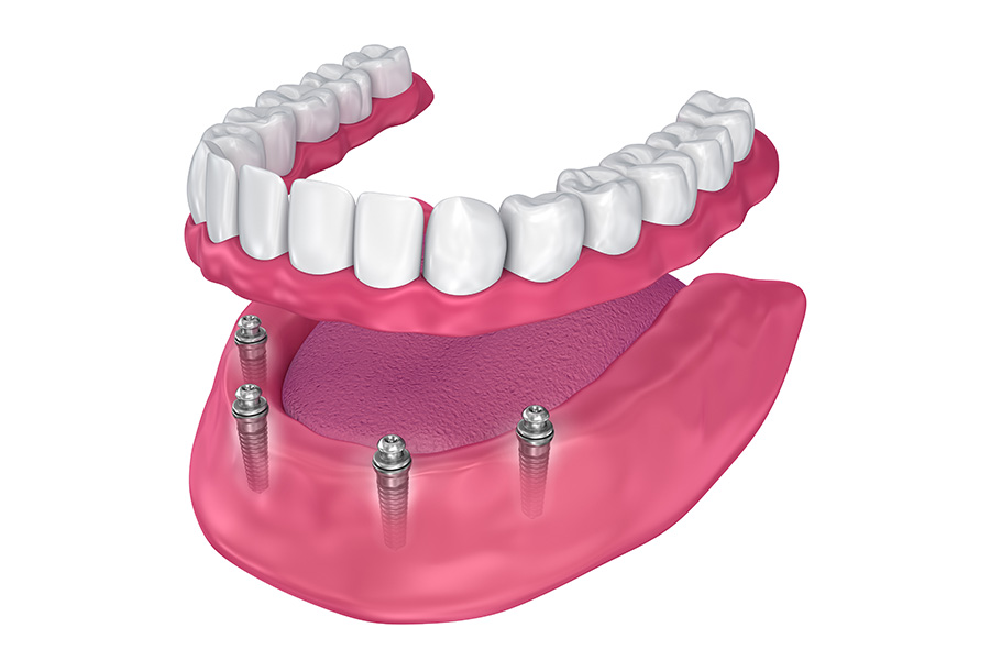 Elite Dental Club | Digital Radiography, Dental Cleanings and CEREC