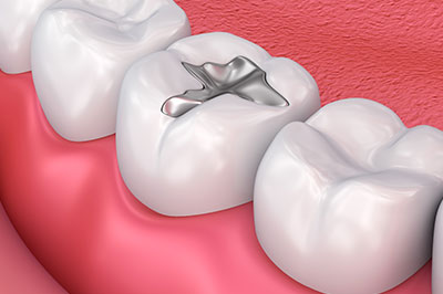 Elite Dental Club | Emergency Treatment, Digital Radiograph and Crowns  amp  Caps