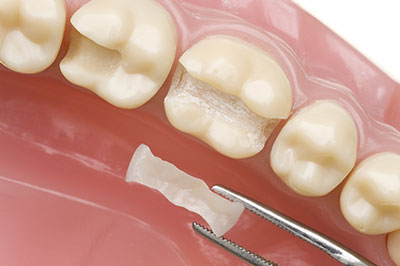 Elite Dental Club | Dentures, Dental Bridges and Veneers