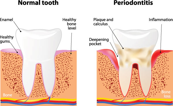 Elite Dental Club | Dental Bridges, Crowns  amp  Caps and Cosmetic Dentistry